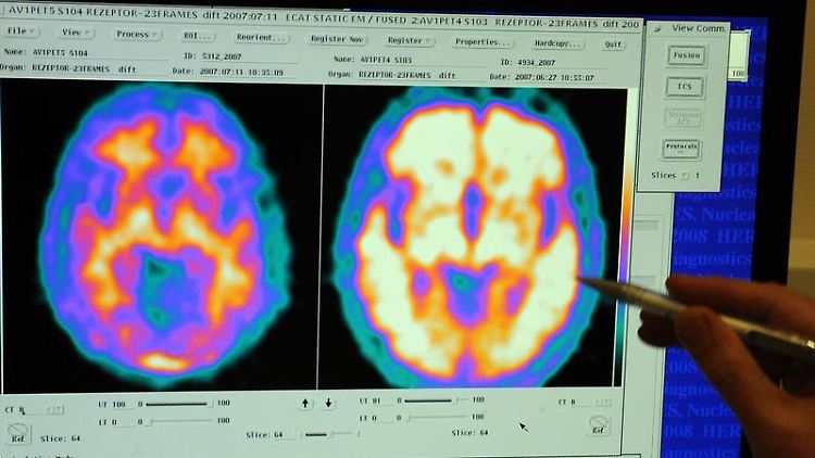 Vergleich zweier Hirnaufnahmen - links von einem gesunden Probanden, rechts von einem Alzheimerpatienten.