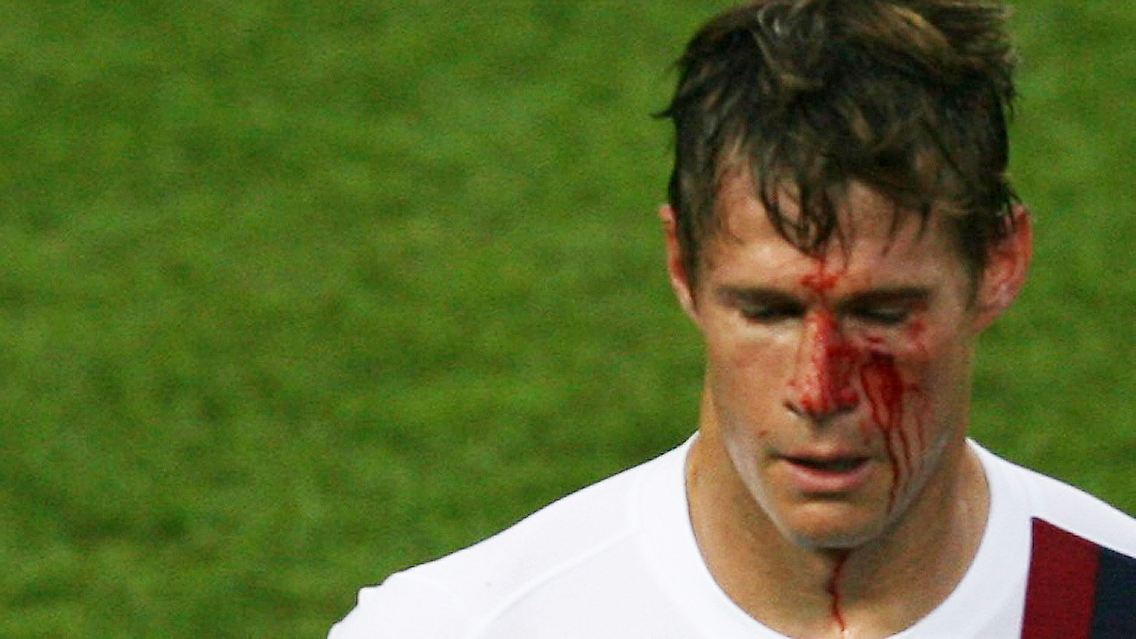 WM 2006: Der Amerikaner Brian McBride nach seinem Aufeinandertreffen mit De Rossis Ellbogen.