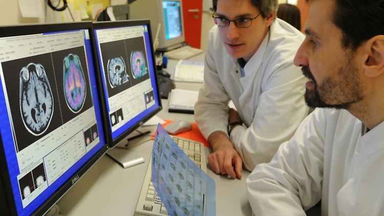 Veränderungen im Gehirn weisen auf eine Alzheimer-Erkrankung hin.