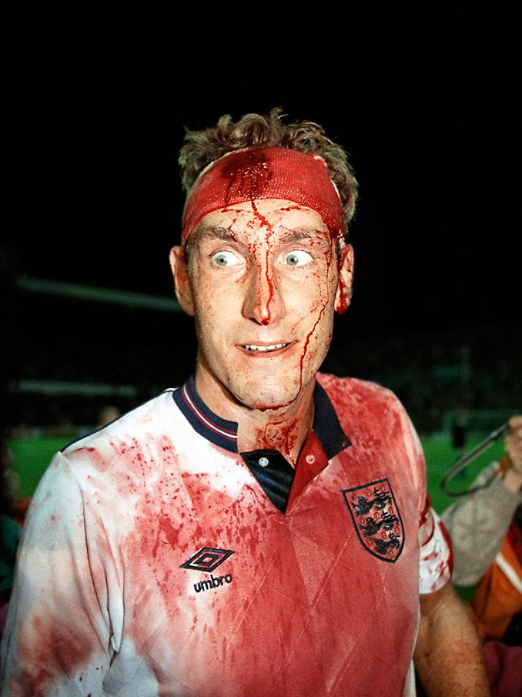 Da guckst du! Terry Butcher, harter englischer Hund, dem selbst eine Kopfverletzung nicht vom Spiel fernhalten kann.