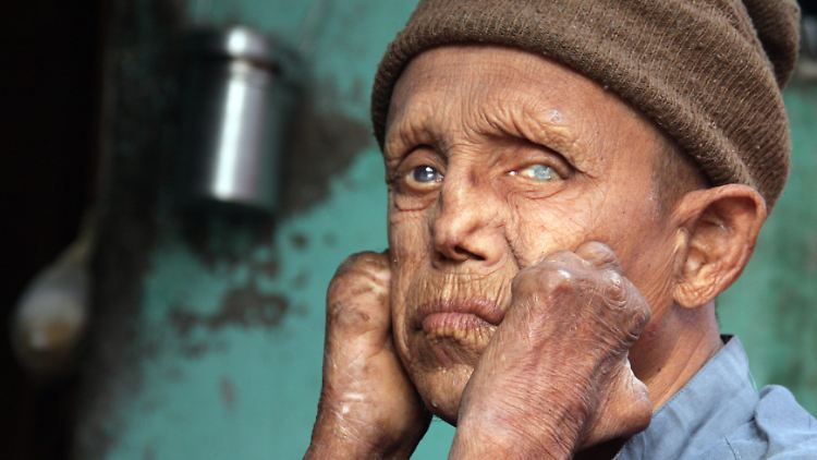 In Europa ist Lepra lange ausgerottet. In Indien zerstört die Krankheit dagegen noch immer das Leben Tausender Menschen.