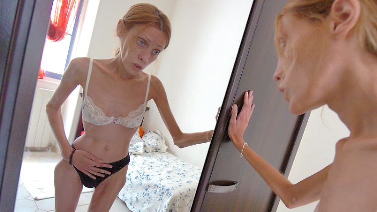 Das verstorbene französische Model Isabelle Caro ist wohl die bekannteste Magersüchtige.