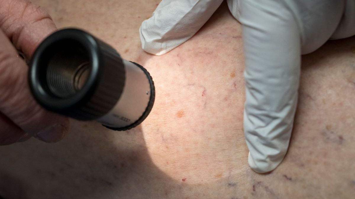 Hautkrebs in Hessen ungleich verteilt