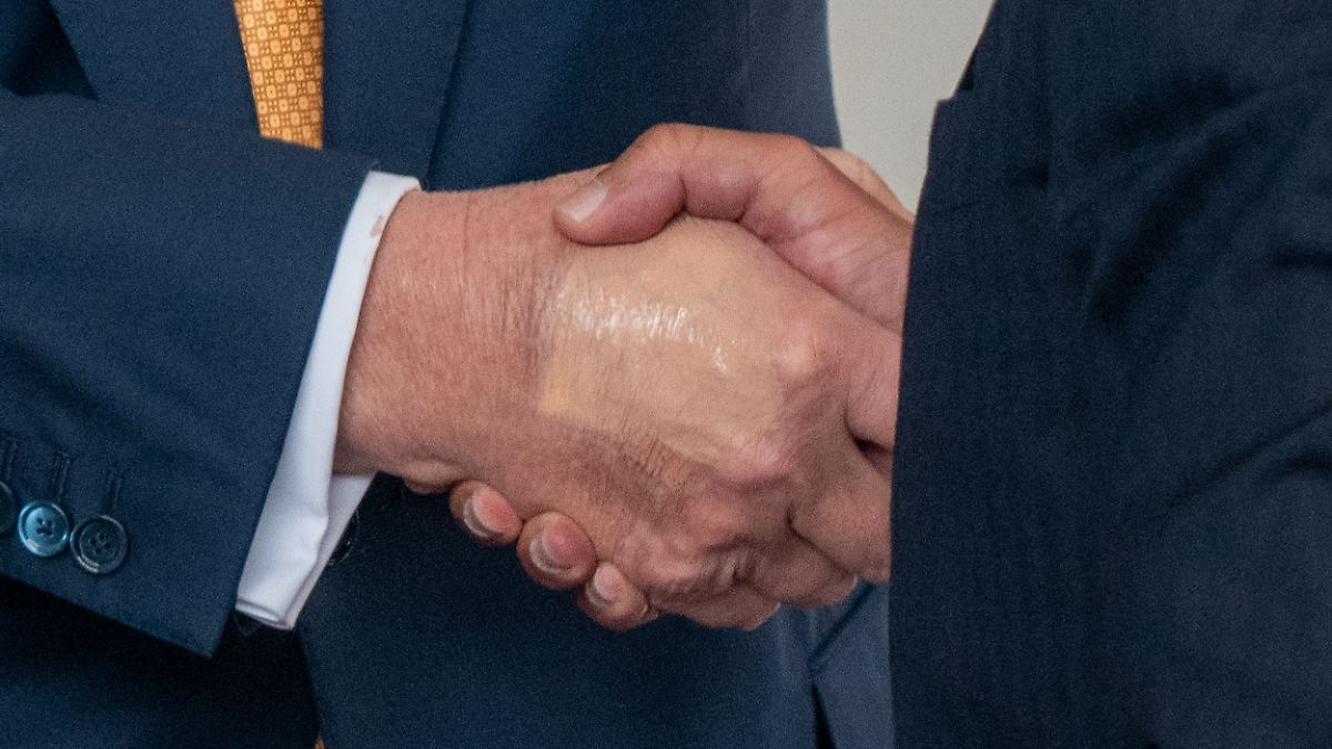 Trump hat eine "chronische Veneninsuffizienz"